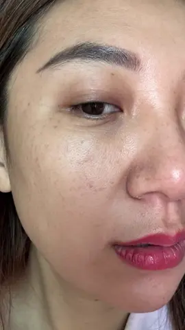 Từng nghĩ sẽ phải sống với nám cả đời… Ai ngờ nhờ kiên trì điều trị… Da sáng hơn, nám mờ dần… Và giờ mình tự tin gấp bội ✨.   #xuhuong #xuhuongtiktok #nám #dalieu #làmđẹp 