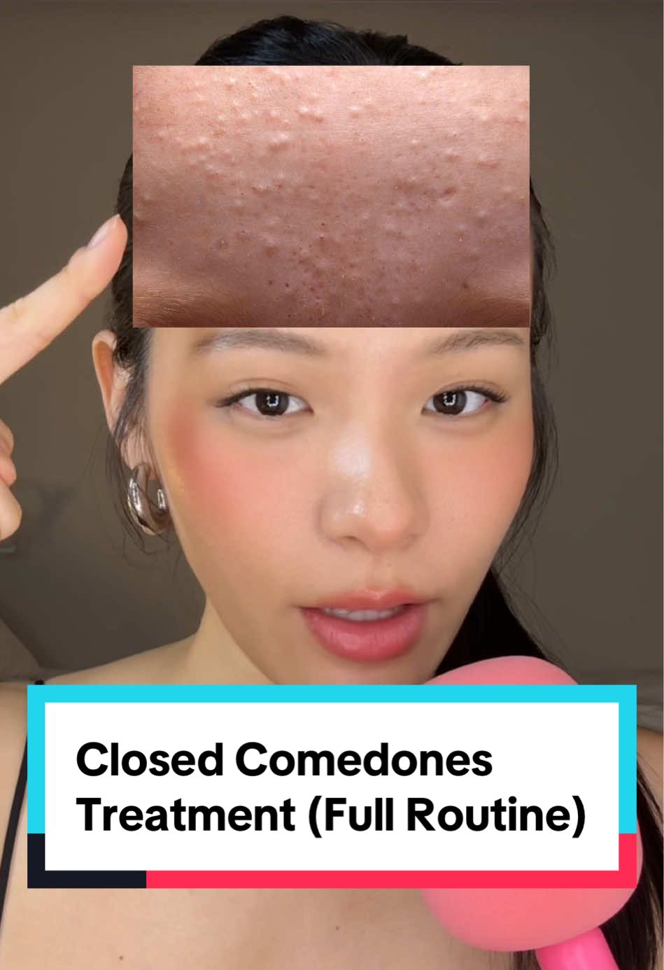Sharing you a full routine to treat closed comedones! All of them are linked to my profile link ;) Get it half the prize because it’s on October Amazon Prime day sale right now ⏰⏰⏰ #amazonprimeday #amazonfinds #primebigdealdays #octoberprimeday #anuadoublecleansing 