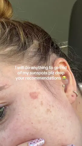 Help me get rid of my dark spots please!! Brands, laser, anything! #darkspots #sunspots 