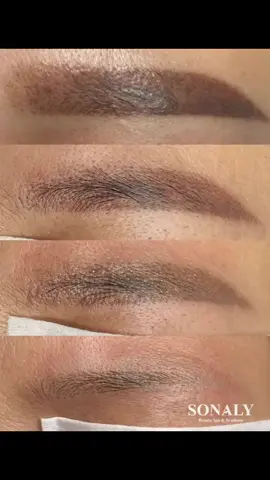 Nghe mọi người bảo nền đỏ khó xoá. Mời các quý anh chị xem kết quả xoá châ mày trổ đỏ với laser tiền tỉ nhà em. #phunxamthammy #sonaly #xoaxamlaser #xoaxammimat #xoaxam #sonalyxoaxam #xoaxamlongmay 