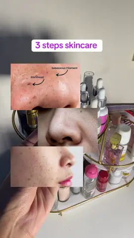 Simple skincare routine for blackheads/ whiteheads/ acne marks  Facewash @SkinEra Life Sciences  Serum @Trego  Moisturizer @Organic Traveller  . . . . . . . . . . . . . . . . . . . . #acne #blackheads #whiteheads #tiktokalgorithm #viral 