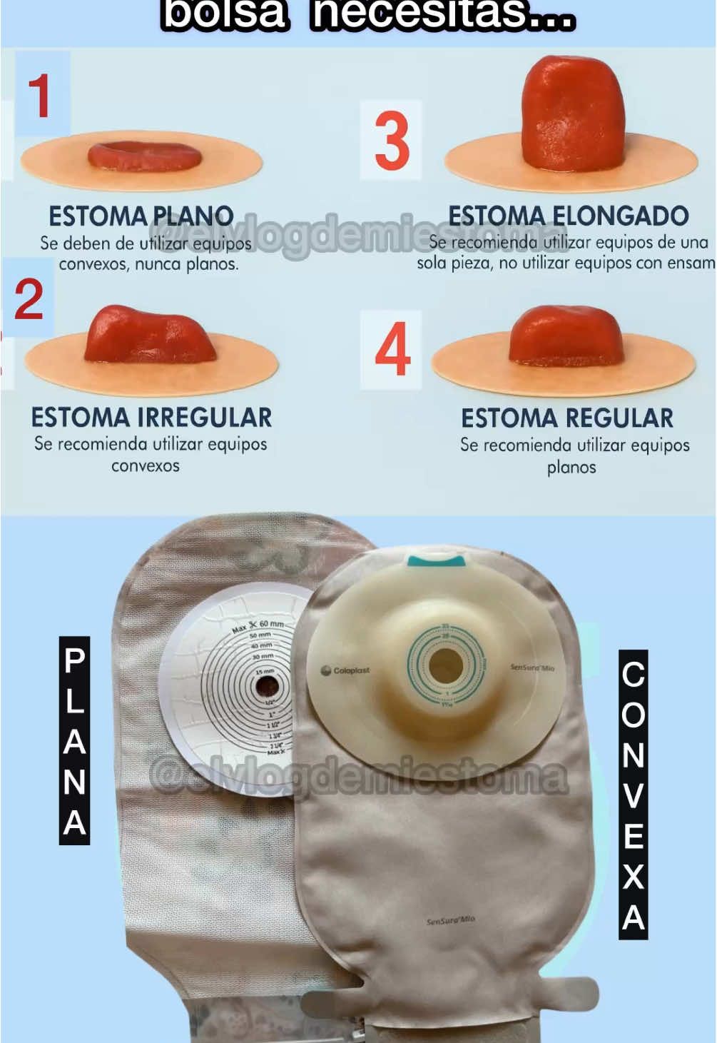 Holaa ✨ yo tengo estoma 2 y uso bolsa de ileostomia convexa… y tu? Que estoma tienes y que bolsa de colostomia/ileostomia usas? #colostomybag #ileostomy #cancerdecolon #ostomy #ostomate 