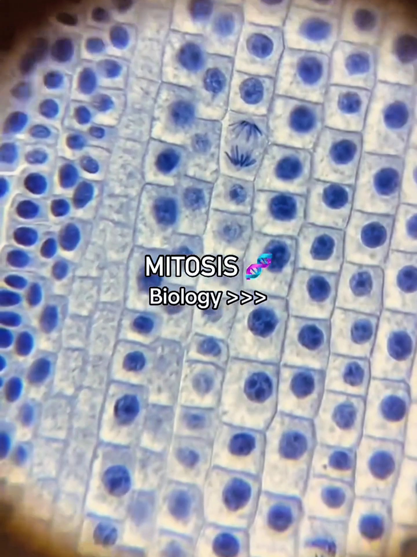 Mitosis, Have you people ever seen Mitosis in Real Life 👀😎🔬 Mitosis is the process of cell division that produces two genetically identical daughter cells. It has four main stages: prophase, metaphase, anaphase, and telophase. The chromosomes duplicate, align at the cell’s equator, and are pulled apart to opposite poles. Finally, the cell splits (cytokinesis), ensuring equal genetic material in both new cells.#medical #student #hospital #fyp #fypdong #uti #meditation #fypgakni