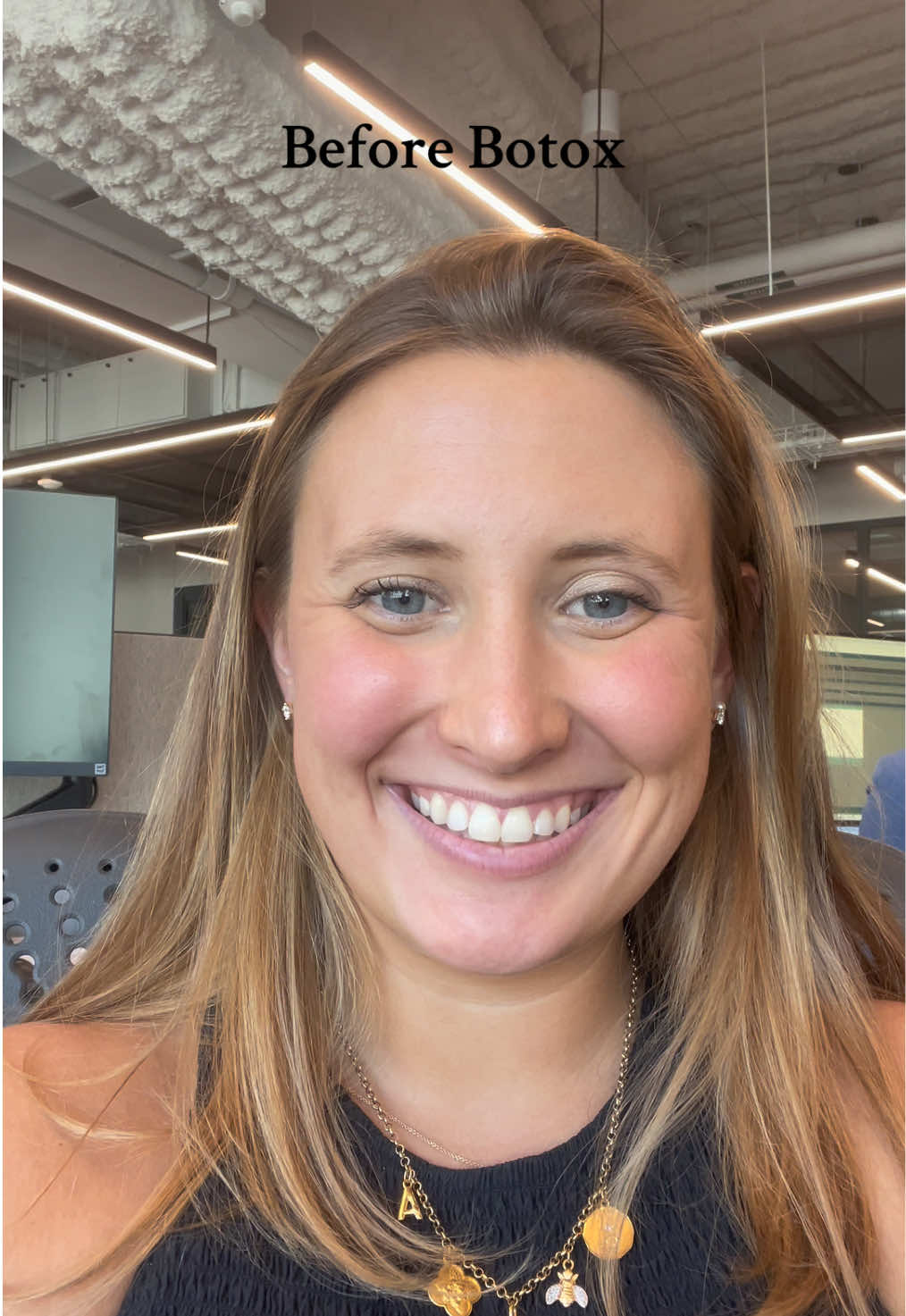 Decided I wanted to try Botox ahead of my wedding. Here are my results with a lip flip and crows feet. What do you think!? #botox #GlowUp #weddingprep #nyc #fyp 