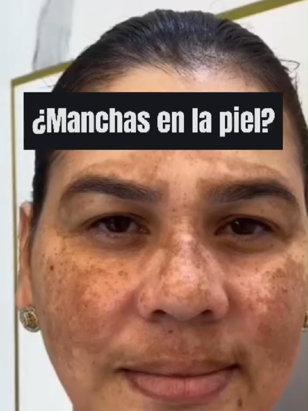 🌟 ¿Manchas en tu piel? Descubre la crema que en SOLO 3 semanas promete dejar tu rostro uniforme y radiante 💖 #paratii #CuidadoFacial #TikTokMadeMeBuyIt #manchasenlapiel