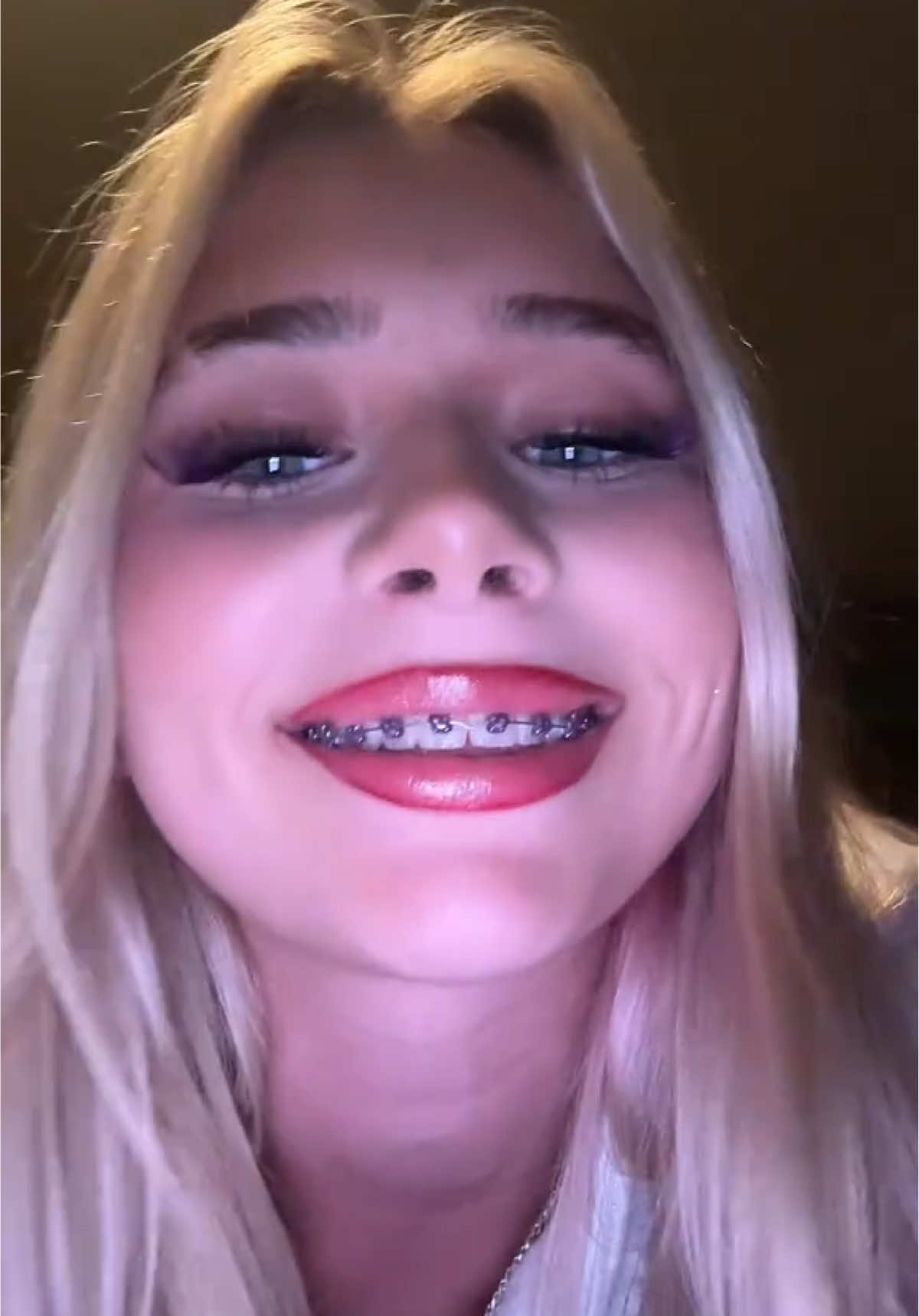 braces eat you up don’t they #fyp #fypシ゚viral #blowthisup #boptok #braces 