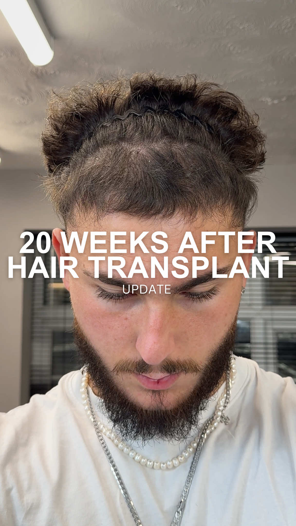 20 weeks post hair transplant results  If you are interested in a transplant where I went, comment below. #hairtransplant #partialshavenfue #fuetransplant #recedinghairline 