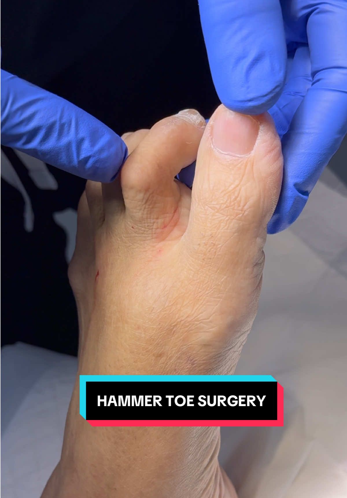 Impeccable results 👣✨ #hammertoe #surgery #orthopedics #foot##fyp 