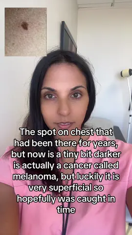 This is a real life melanoma and I  really needed to twist an arm to biopsy but so glad I did #melanoma #fyp #dermatologist 