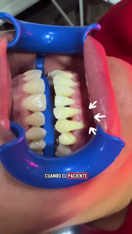 Así luce tu sonrisa después de eliminar el sarro 💎  #LimpiezaDental #Odontología #AntesYDespués #SonrisaSaludable #dentistalavictoria