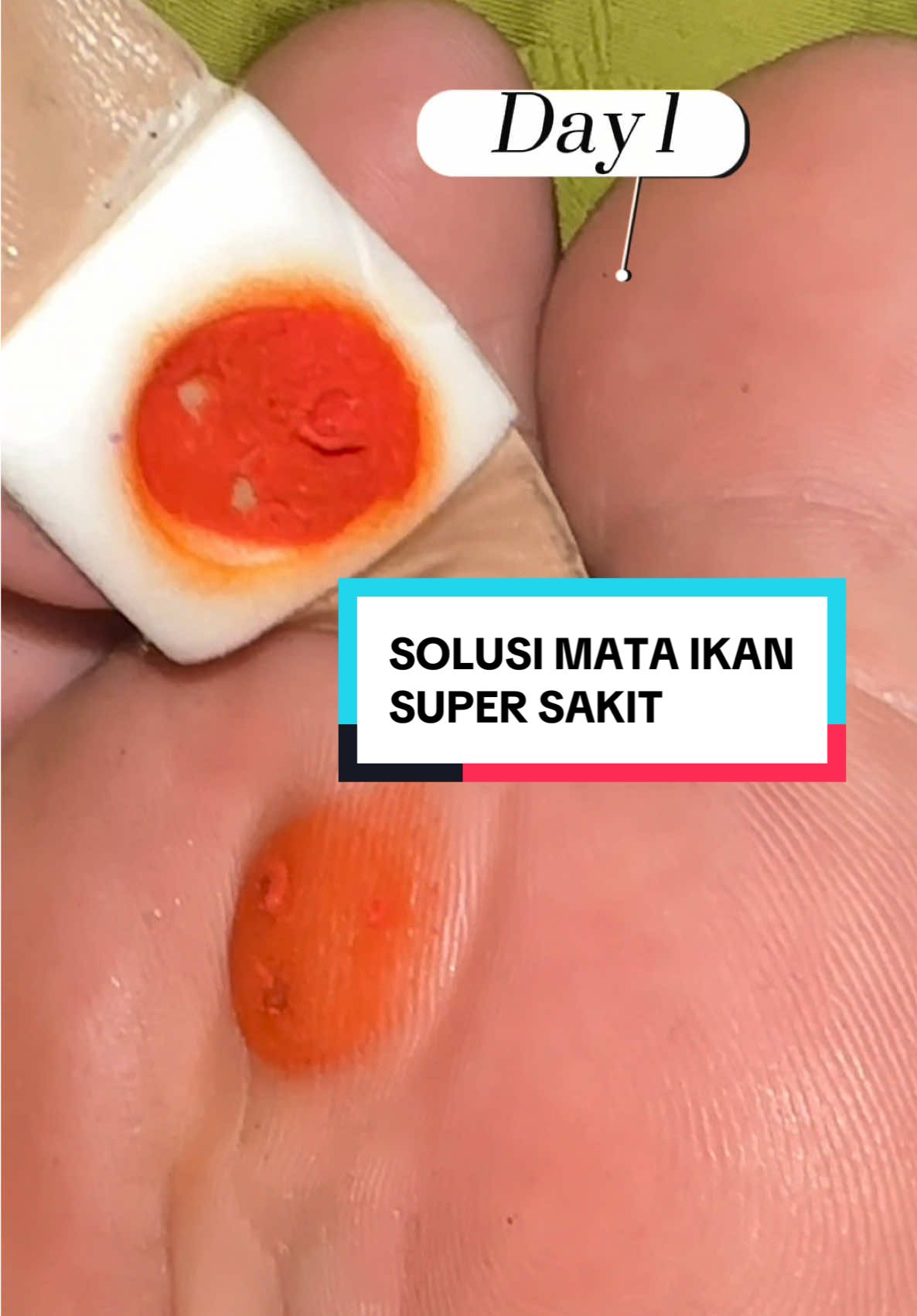 Mata ikan tuh kecil aja sakit bgt! Jalan sampe miring2. Untung nemu solusi mata ikan tinggal tempel.. Ini bisa juga untuk kapalan ya.. #plestermataikan #mataikan #solusimataikan #obatmataikan 