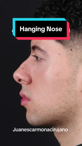 #fyp #parati #foryou #rhinoplasty