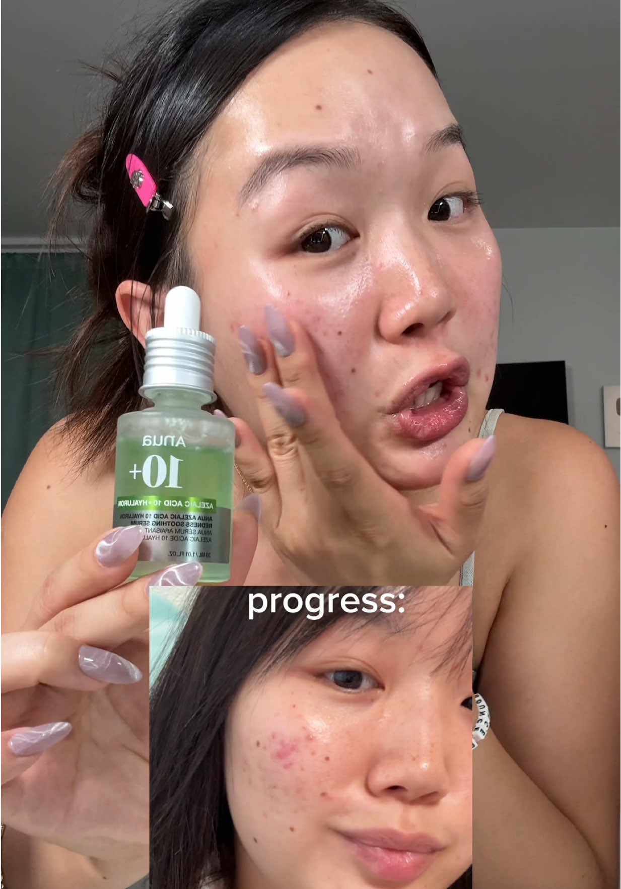 Replying to @Who’s this?  Don’t forget to thank me later! Link in bio 🤭💚 #acne #skincare #anuaazelaicacidserum #acnetreatment 