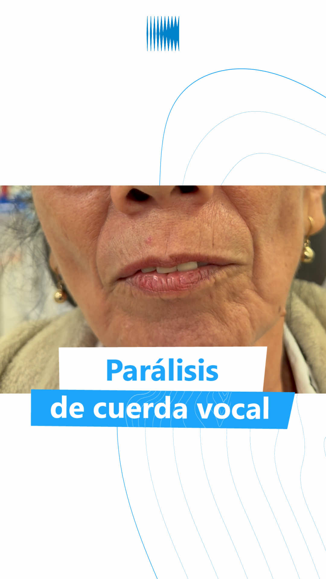 La parálisis de cuerda vocal puede causar ronquera persistente, voz débil, fatiga al hablar e incluso dificultad para respirar. Pero con el tratamiento adecuado, es posible recuperar claridad, fuerza y seguridad al comunicarse. En este video compartimos cómo, con técnicas especializadas, ayudamos a devolver la voz y la confianza a nuestros pacientes. Porque cada voz que vuelve… es una vida que se transforma. 💜 📍 Calle 106 #17-45, Bogotá, Colombia 📲 315 348 4857 #ElevaTuVoz #ParálisisDeCuerdaVocal #RecuperaTuVoz #SaludVocal 