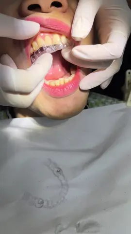 Lên khay tiếp theo nè #chinhnha #niengrang #bacsichinhnha #niengrangkhaytrongsuot #invisalign 