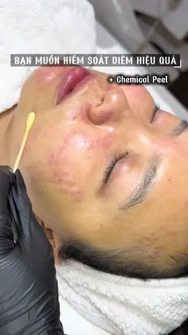 Muốn kiểm soát mụn đừng bỏ qua e peel này nhé #xhtiktok #fypシ゚viral #goclamdep #laymunchuanykhoa_sadec 