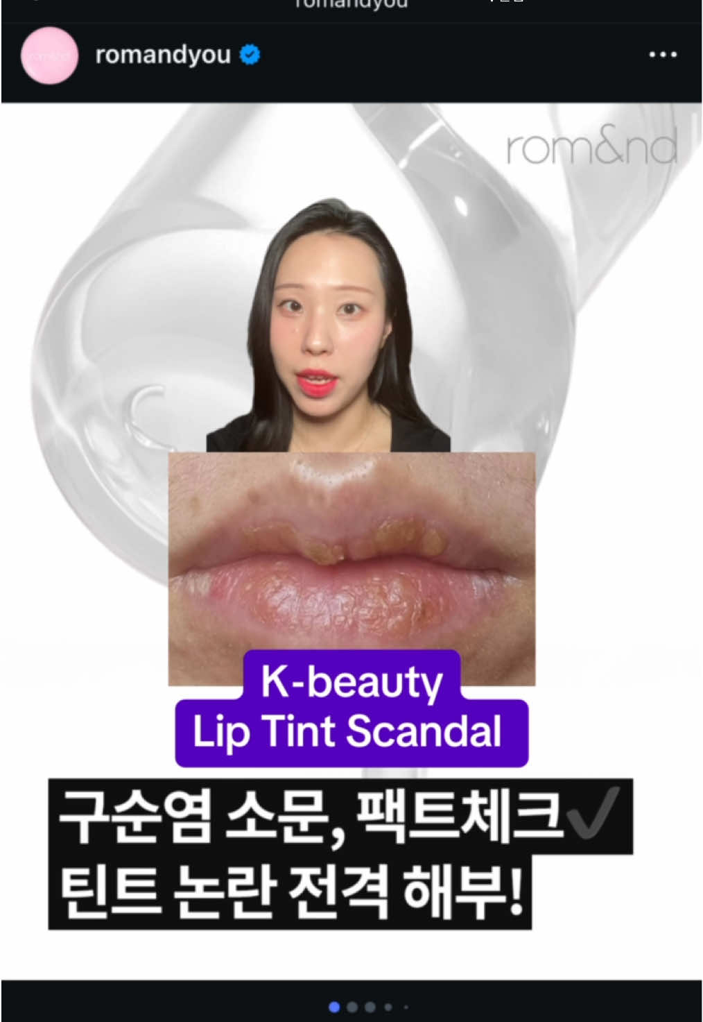 Rom&nd lip tint scandal 🔥  The viral Juicy Lasting Tint is facing complaints of allergic reactions.  Many long-time fans are now questioning product safety and sharing their experiences online, sparking a wider conversation about K-Beauty transparency, ingredients, and consumer trust. 👉 Have you ever tried Rom&nd’s lip tints? Did you experience any reaction? Share your thoughts below. #romand #kbeauty #koreanmakeup #liptint #juicylastingtint 