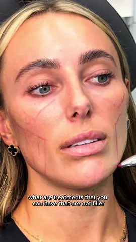 No filler needed… We’re treating Amber Turner with Croma Polynucleotides under the eyes and Polyfill Next (a blend of Profhilo + Polynucleotides) 🧬  This treatment doesn’t add volume - instead it stimulates collagen, restores elasticity, and boosts deep hydration for brighter, healthier-looking skin! Amber is always glowing, and we’re helping her maintain it with these treatments 🤍 If you’re looking for skin rejuvenation without filler, these treatments are the go-to for natural, long-lasting results! 💾 Save this post for later if you want to remember the best treatments for glow, collagen + moisture retention! Got questions? Drop them here and we’ll answer!#profhilo #fyp #injectables #amberturner #glow 