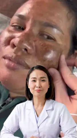 Mabilis at effective na paraan para mawala ang melasma? Watch this video! 🤩 #fyp #trending 