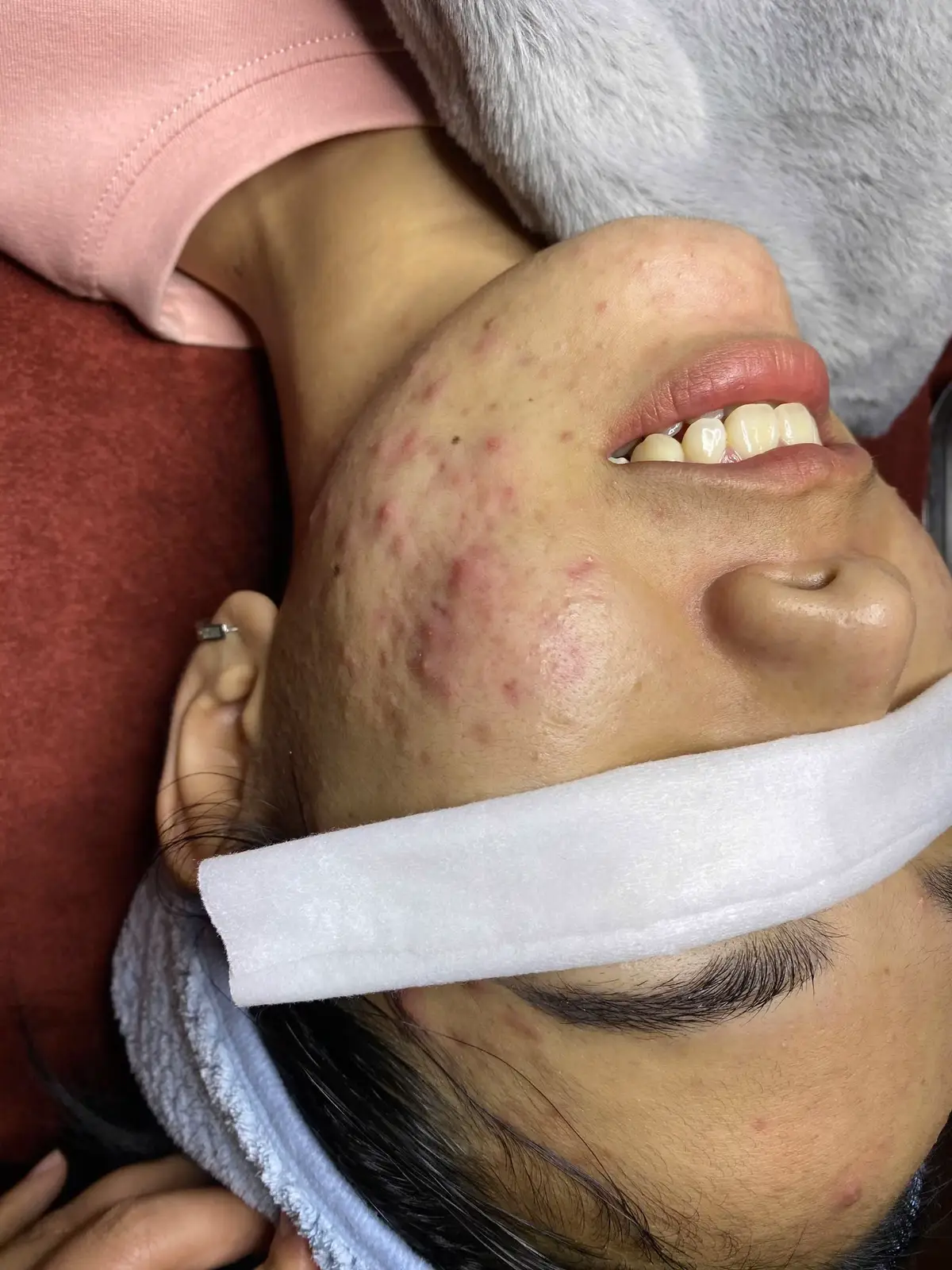 Mụn thật sự đtri rất đơn giản và hiệu quả luôn