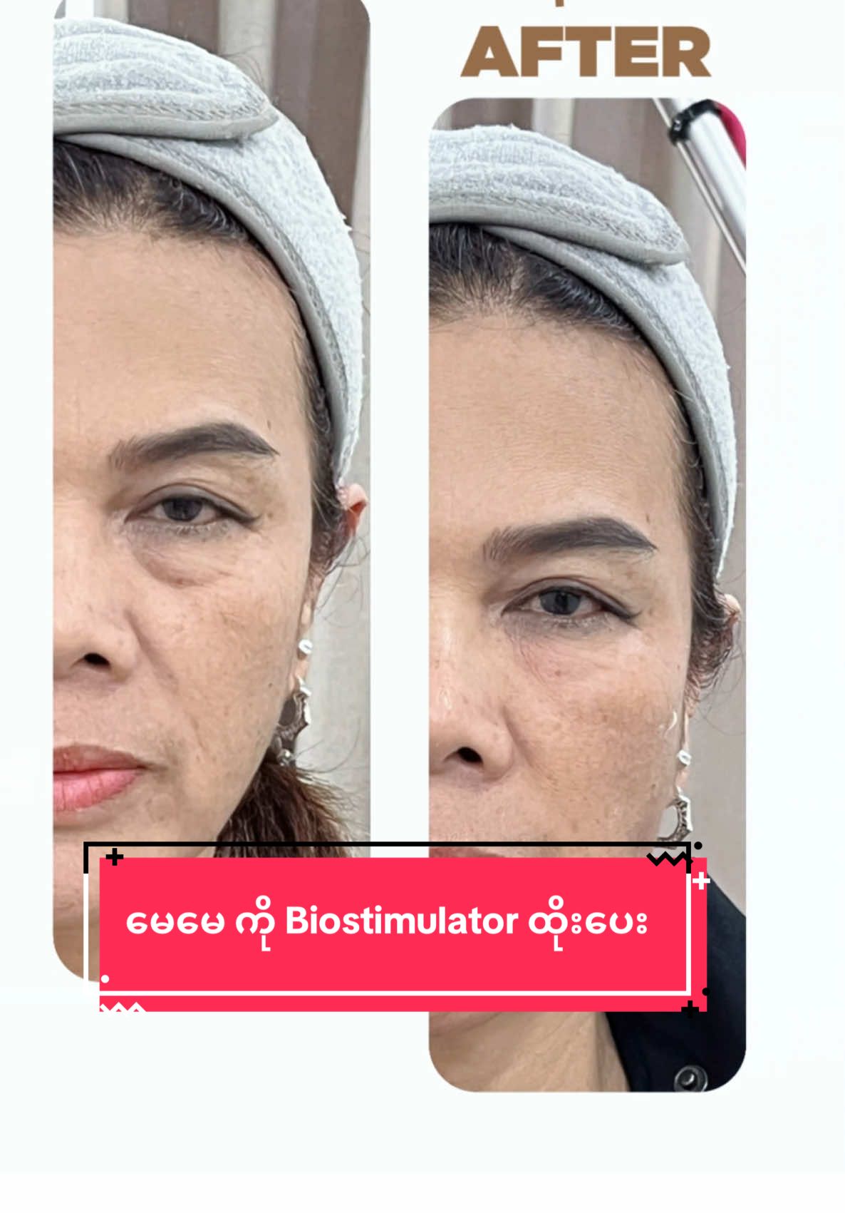 မေမေ ကို Biostimulator ထိုးပေး 🤍filler , botox မထိုးချင်တဲ့သူတွေ သဘာဝကျကျ  collagen တွေထွက်ပြီး ပြန်နုပျိုတဲ့ ရုပ်သွင်ကိုရစေပါတယ် #drshu #glassskinaesthetics #biostimulator #collagen #antiaging 