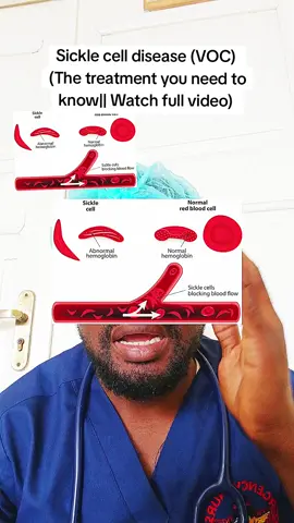 Sickle cell disease#SCD#VOC#sicklecelldisease💉❣#emergencynursespecialist 
