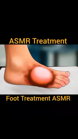 ASMR Treatment| Foot Treatment #asmrtreatment #skincareasmr #newtrend #foryou #foryoupage 