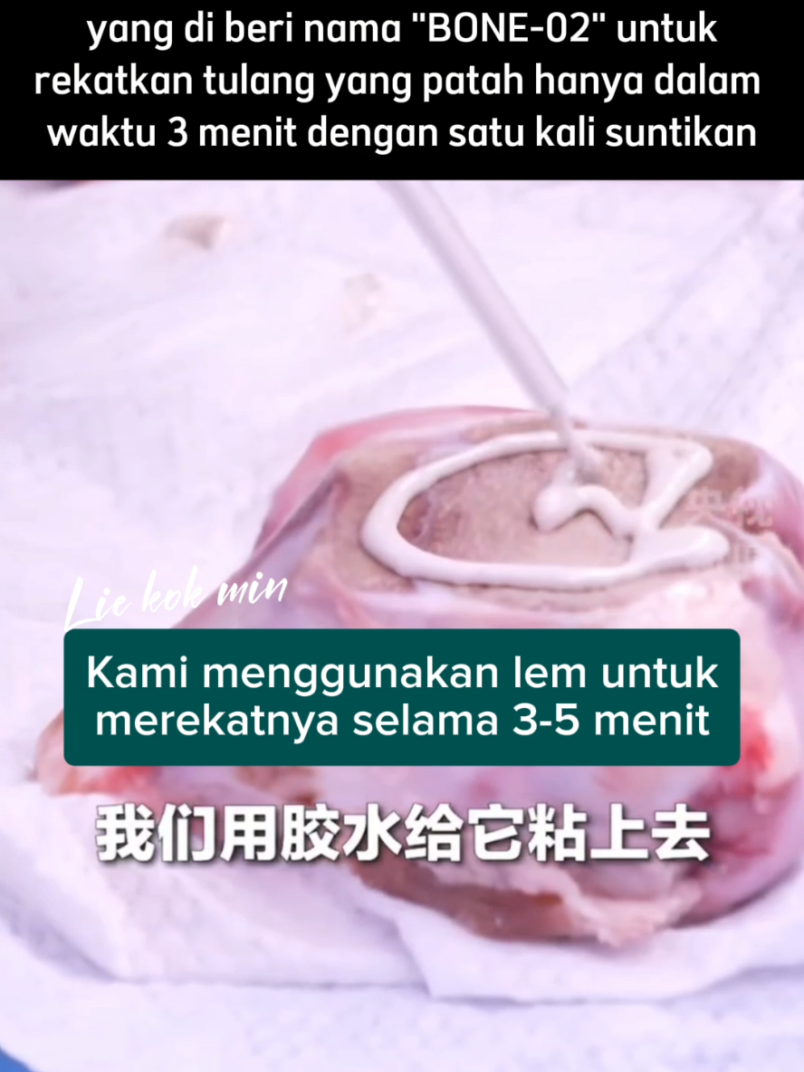 Ilmuan Tiongkok temukan Lem Khusus untuk merekat tulang yang patah sehingga di masa depan pasien patah tulang tidak perlu lagi melakukan operasi pemasangan pen dan sekrup. Saat ini lebih dari 150 pasien di Tiongkok telah menerima tindakan ini dan mencapai kesembuhan yang jauh lebih cepat di banding pasien operasi pemasangan pen