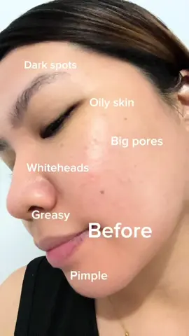 I used to avoid close-up photos because my skin looked so dull and uneven 🥲. In the “before,” you can see dark spots, oily shine, and roughness. After using this Vitamin C Brightening Masque, my skin looks clear, smooth, and so much brighter. It’s like my face finally reflects the energy I feel inside. This is the kind of result that makes you actually want to take selfies again ✨. #GlowJourney #SkinEverCare #OTWOOArabia #VitaminCGlow #BeautyTok 