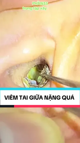 PHẦN35 Viêm tai giữa quá nặng luôn trời #raytai #viemtaigiua #raytainamnu #layraytaicocamera #trungtapxaykenh 