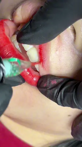 Đi lòng môi trên #phunmôitựnhiênbìnhthạnh #khuthammoisaigon 