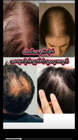 #၀၉၇၉၁၆၀၄၃၉၆💯 #ဆံပင်ကျွတ်သက်သာပီးအုံထူစေဖို့ #ခိုင်ကြိတ်မှန်မှုတ် #ရောက်ချင်တဲ့နေရာရောက်👌 မြဝတီမြို့