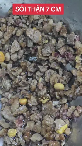 Sỏi thận 7 cm #bacsiduongvantrung #soithan #tansoithan 