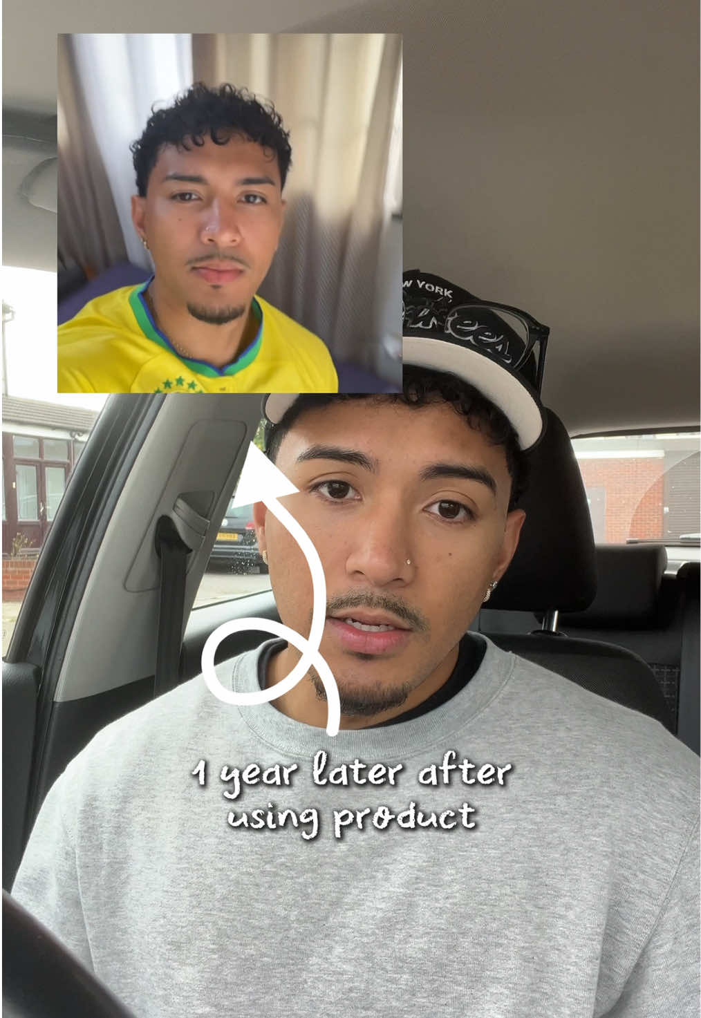 I’ve tried so many different products but this one helped me the most… @The Ordinary Store UK  @The Ordinary  #beforeandafter #skincare #toner #blemishes #acne 