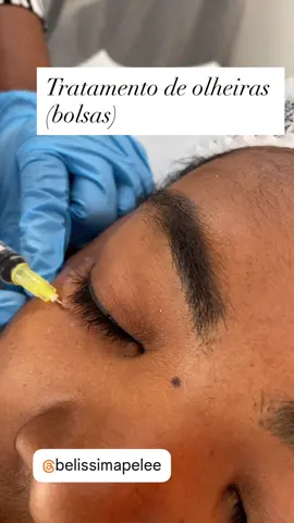 Trabalhamos olheiras Objetivo: Melhorar a microcirculação periocular, modular a pigmentação dérmica e epidérmica, estimular a síntese de colágeno e aumentar a hidratação cutânea, visando reduzir a coloração escura e a flacidez característica das olheiras.