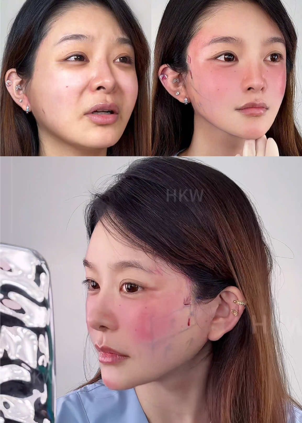 💫 No more puffiness, no more heavy face. The 9D Facelift targets unwanted volume, restores skin firmness, and revives your natural beauty — all in one procedure. 🌹 #9DFacelift #FacialRejuvenation #FacialLiposuction #FacialLift #ForeheadLift