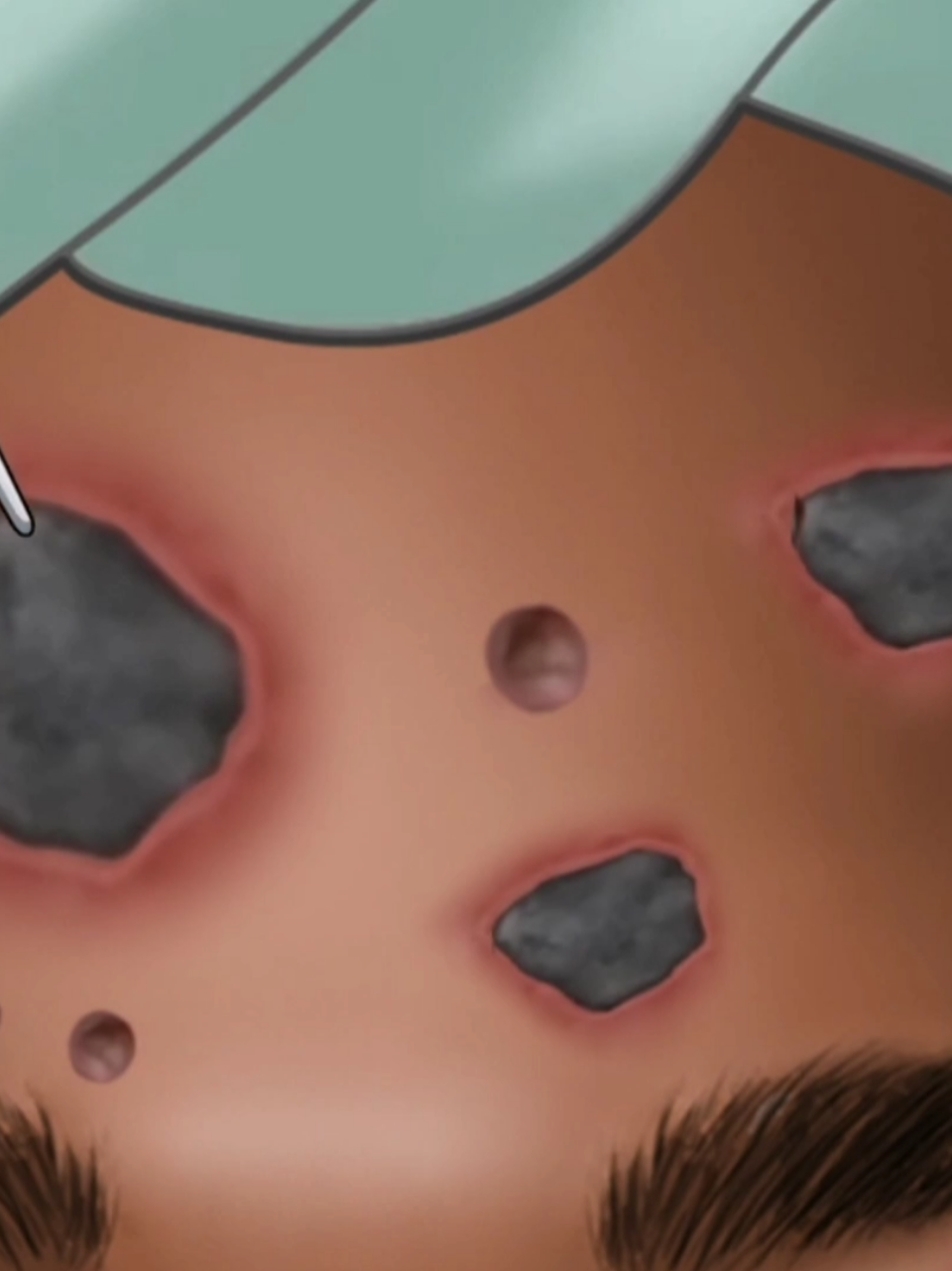 Asmr treatment satisfying video #EYEASMR #asmr #ASMR #acne #viral 