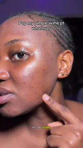 Long time no pimple pop videos no?  My skin has been really clear lately…I stopped using my actives 😝 #pimplepop #pimplepatch #acnepatch #pimplepopper #acneproneskin 