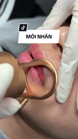 Có ai không thích môi căng mọng đâu chứ ?? #phunmoi #khuthammoi #laserco2  #bacthaysuaxoa #giangelyseeshocvienphunxamquocte 