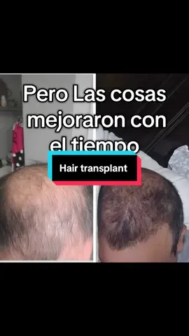 El trasplante de cabello ha sido la mejor inversión de mi vida.