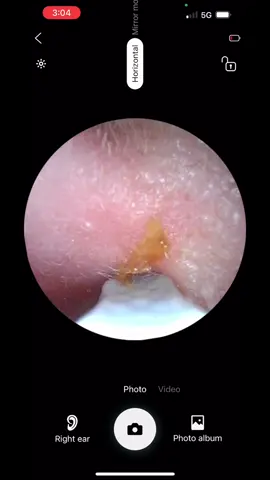 Can’t hear clearly? 👂 It might be ear wax, not your ears. This ear wax removal camera lets you see & safely clean at home. Say goodbye to muffled sound and enjoy conversations, TV, and music in crystal-clear HD again 🎶✨ #EarWaxRemoval #HearingClear #LifeInHD #HealthHack #EarCamera 