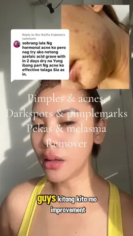 Pimples & acnes, Darkspots & pimplemarks Pekas & melasma Remover #acne #pimple #azelaicacid #acneproneskin #acneskincare 