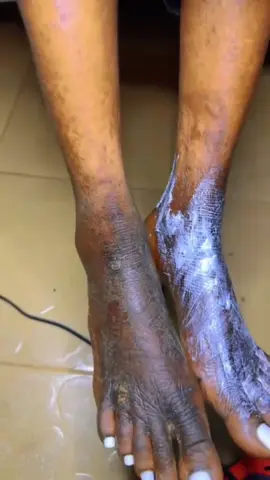 Creme réparateur peeling anti Thiéré urgence claire kit super puissance extra forte rapide Joni Joni anti Thiéré anti tache brûler ☎️ 781406865 #creatorsearchinsights #fpyシ #pourtoi #tachemami #tendance_sur_tiktok #viralsenegal #viralsenegal #lyly #diaspora #vergetures #cosmetics #mamendiayesavon #mainetpiedsnoires #diodioglowskin #toutouastou 