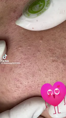 Simple clean pimple popping #trend #face #obsessed #blackhead #beauty 