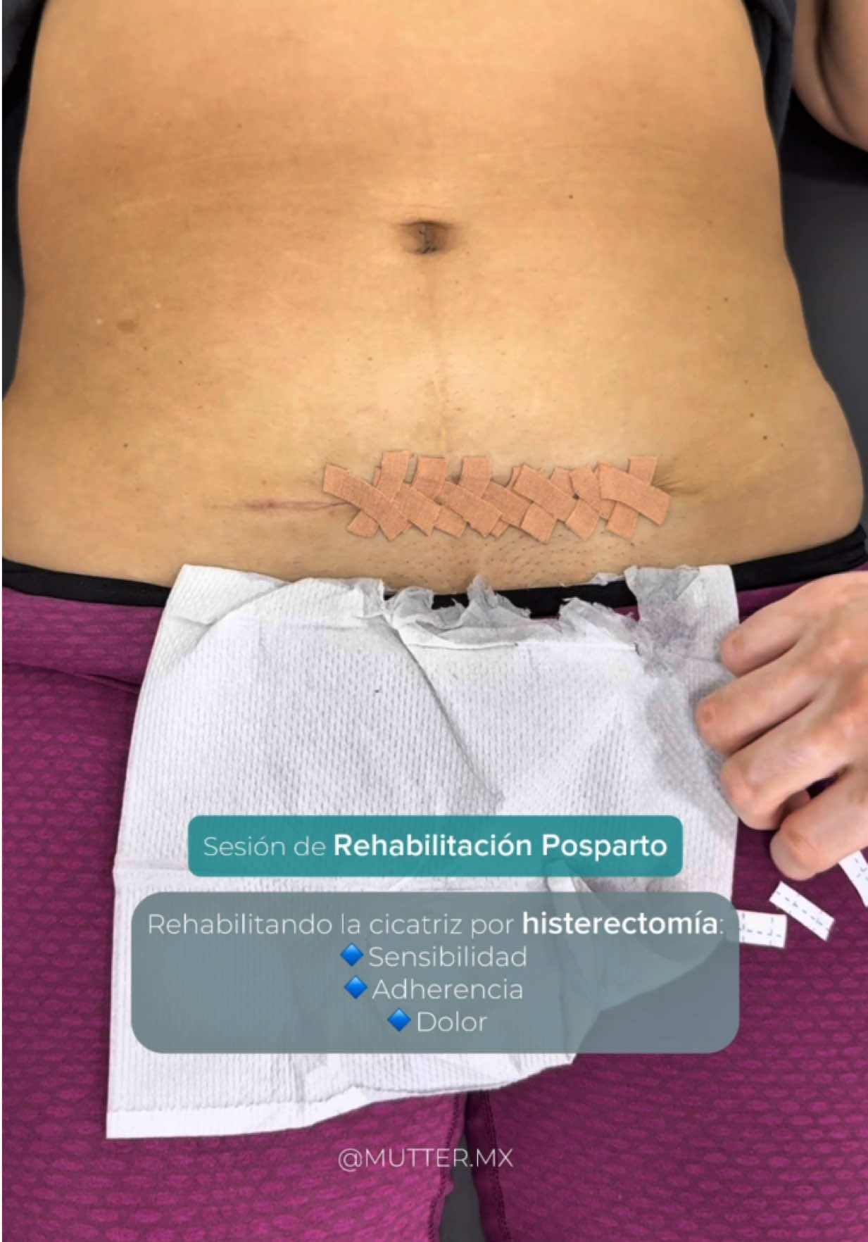 Las cicatrices abdominales también necesitan de rehabilitación sobre todo cuando hay DOLOR.  Lo importante será tener una cicatriz funcional y lo estético viene a consecuencia.  #fisioterapeuta #fisioterapia #posparto #cesarea #embarazo 