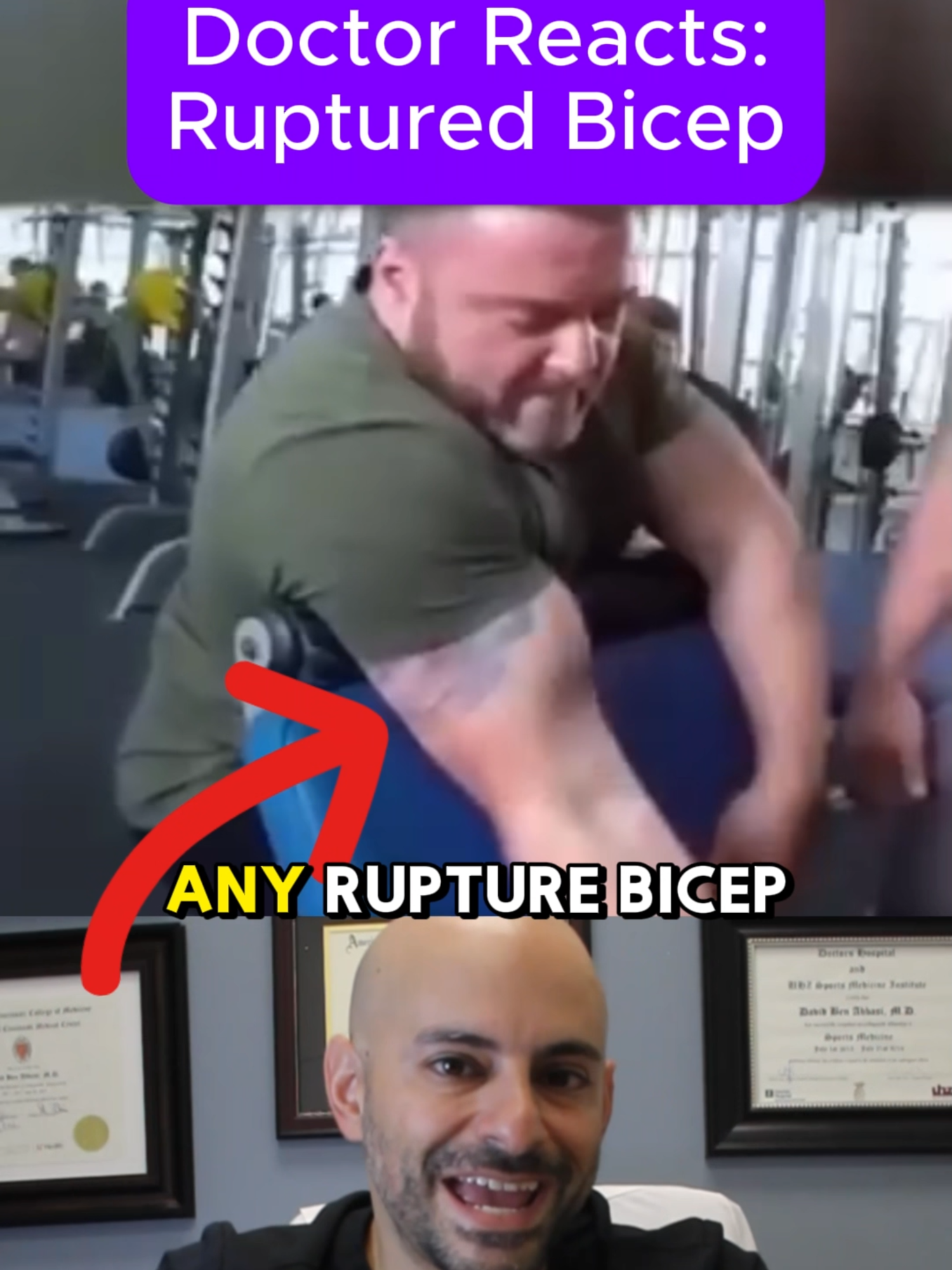 Nasty Bicep Tear😱 This is why I always tell people that anabolic steroids are not worth it! Protect your body by staying natural. #gymfail #biceps #injury