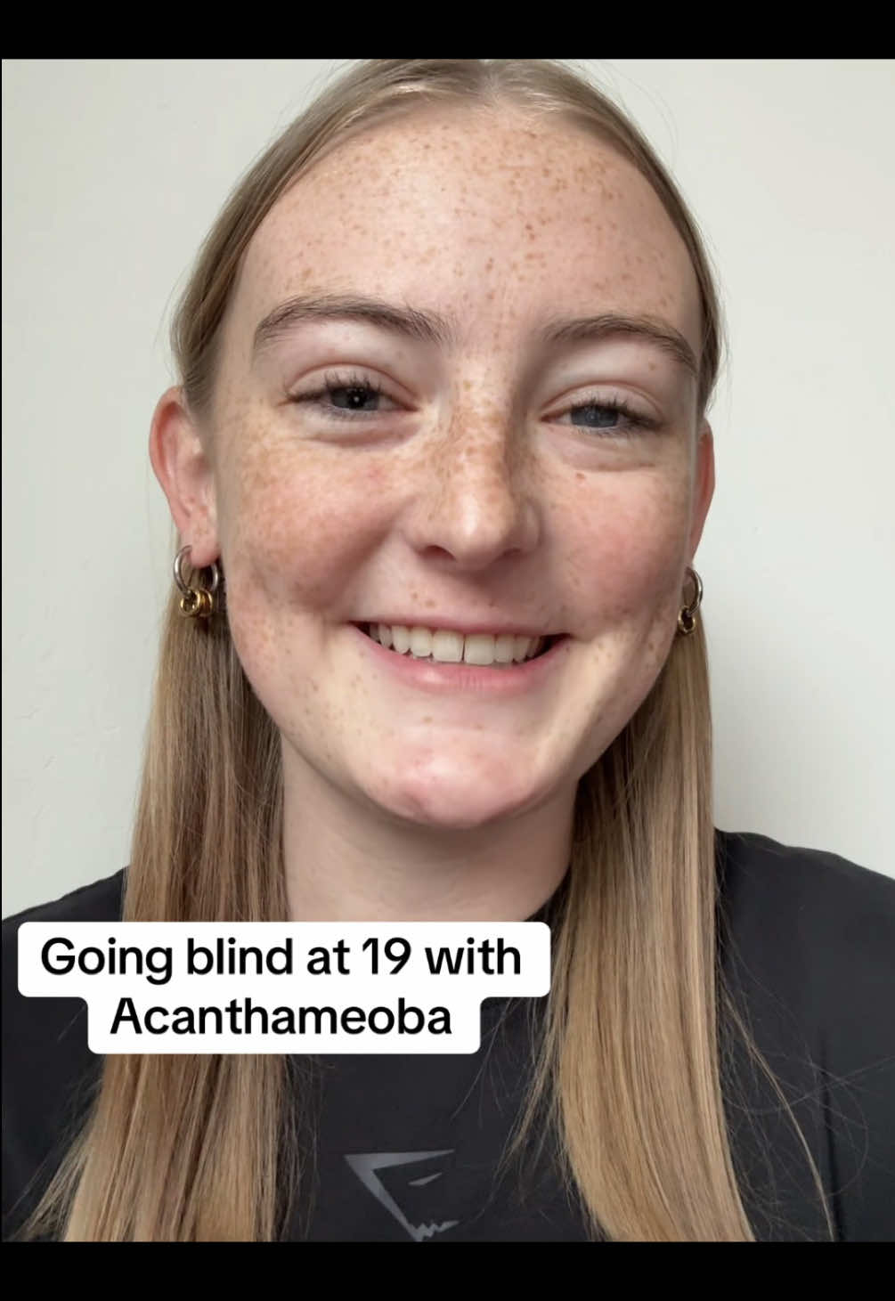 My story of how I’m going blind and how I got Acanthameoba. Please take care of your contacts and never take your sight for granted. Thank you for all of your prayers and support! Jesus loves you! 🫶🏼❤️  For those asking here’s my Venmo: @Grace-Jamison #blind #blindness #eyes #acanthamoebakeratitis #contactlenses 