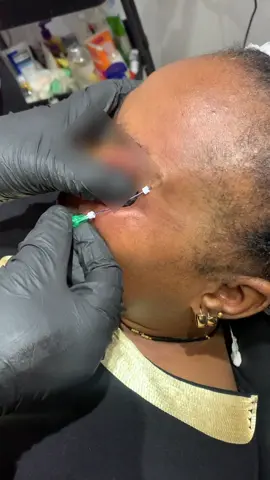 FOX EYE 😍thread lift This treatment is minimally invasive procedure that uses dissolvable threads to lift and elongate the eye in order to create an almond shape while simultaneously lifting the browtail. Individual results may vary  📞 07039242962 to book an appointment now!!! #scarletglowbeautyspa #browslift#pdothreadlift #aestheticclinicinanambra #aestheticclinicinowerri 