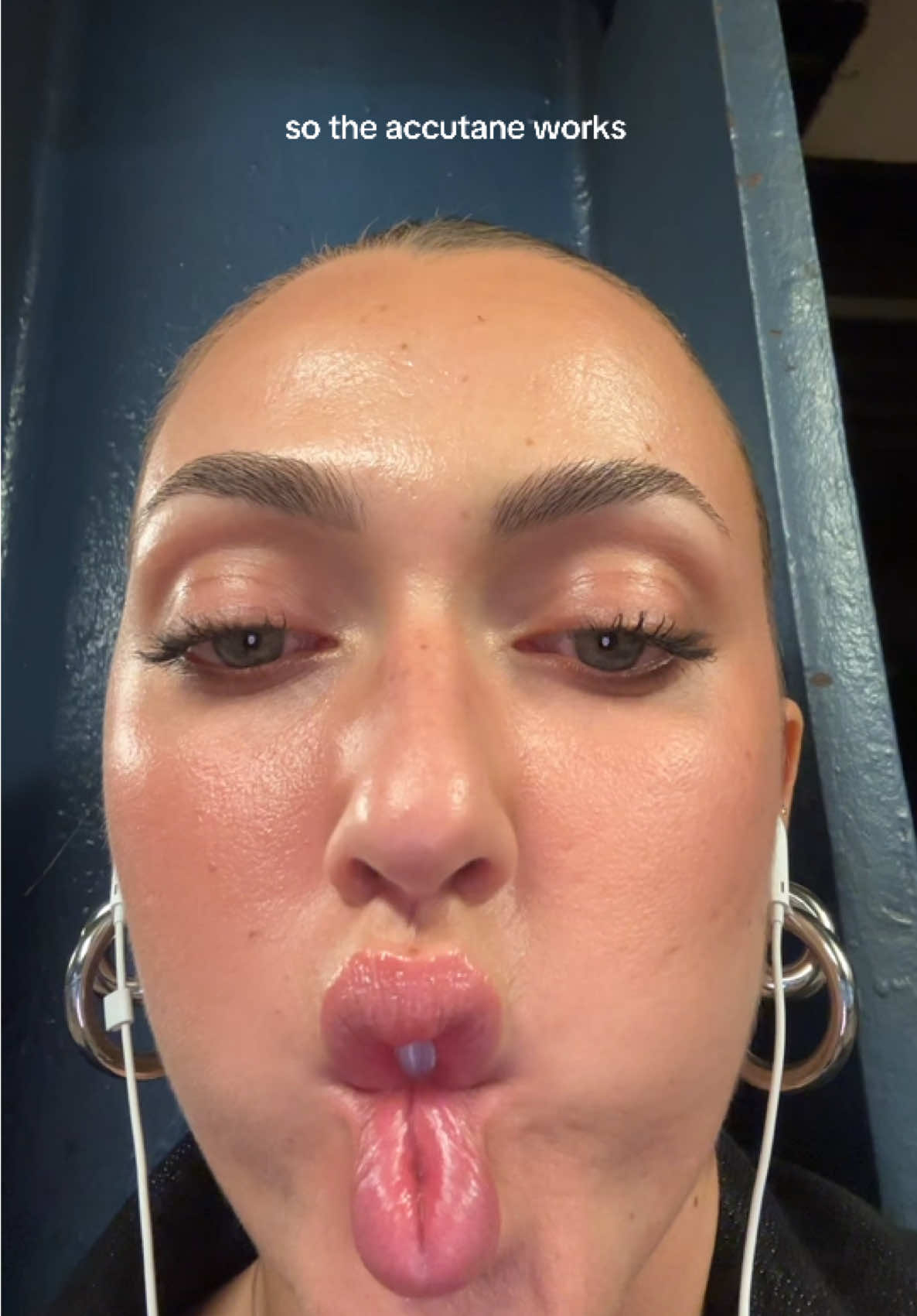 insane results honestly #accutane #acnescars #acnescar #accutaneskin #accutanejourney 
