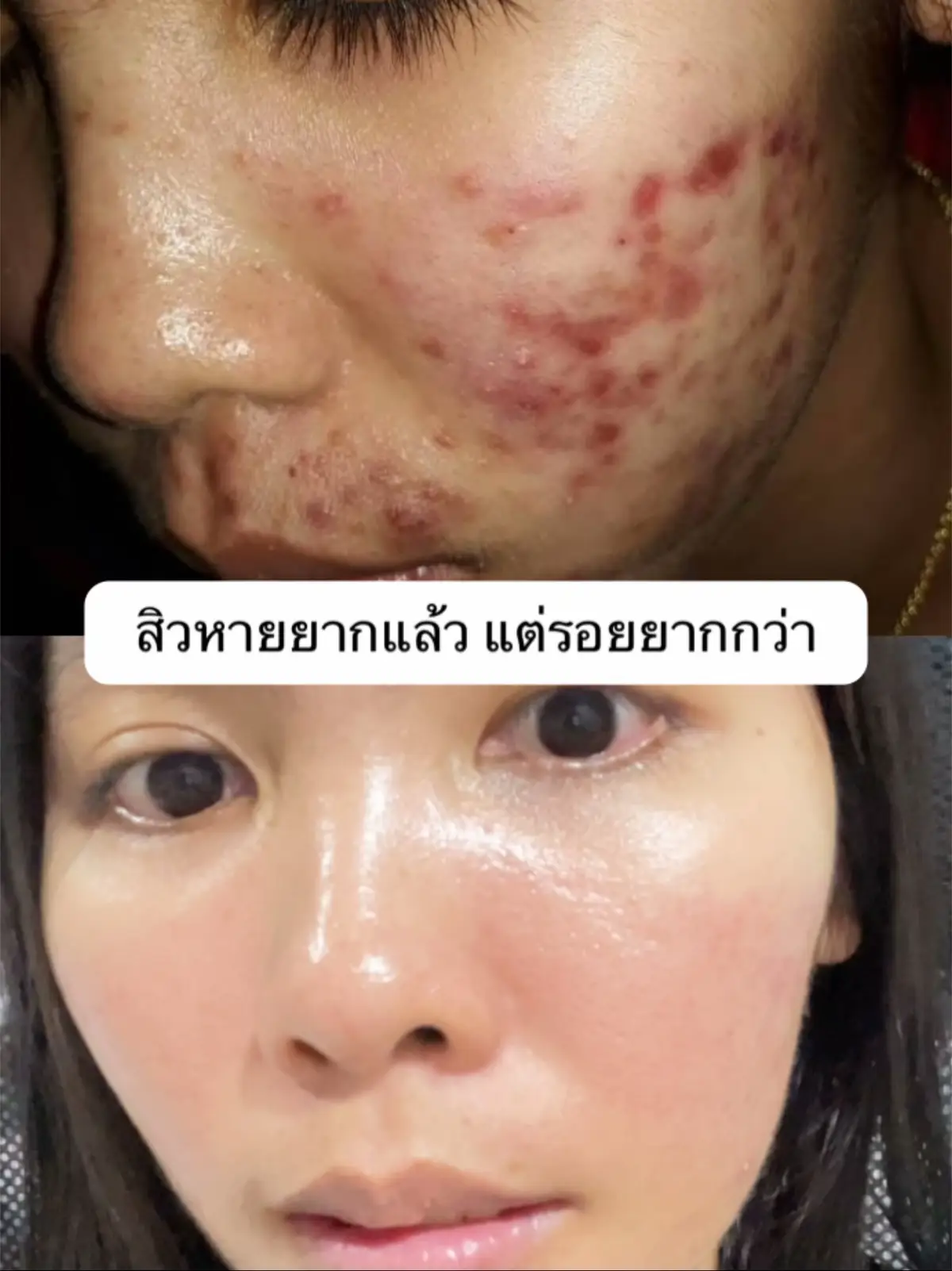 รอยสิวที่ว่าหายยาก #เมเบลมารีวิว #รอยสิว #รอยดํารอยเเดง #ลดรอยสิว #ฟาวเดอร์สกิน 
